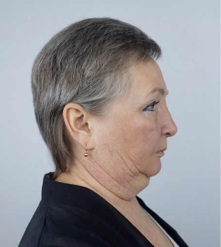 Woman's profile showing aging neck and jawline before cosmetic treatment consultation