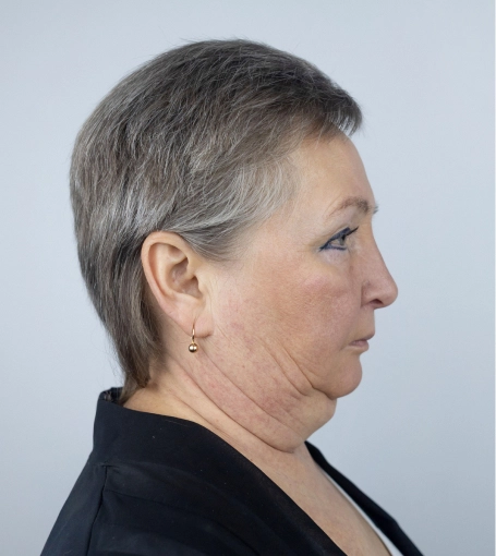 Woman with short gray hair showing neck and jawline from side profile before cosmetic procedure