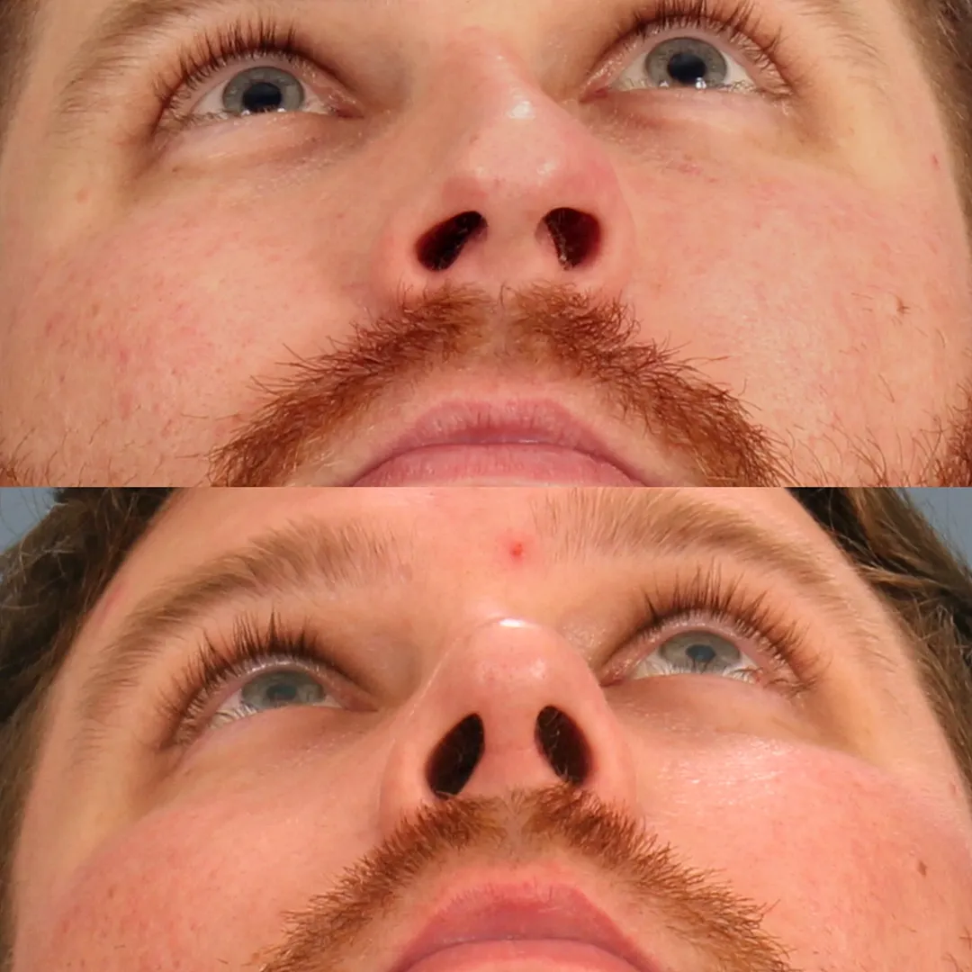 Real patient in Berkeley, CA Performed by Dr David Chou MD