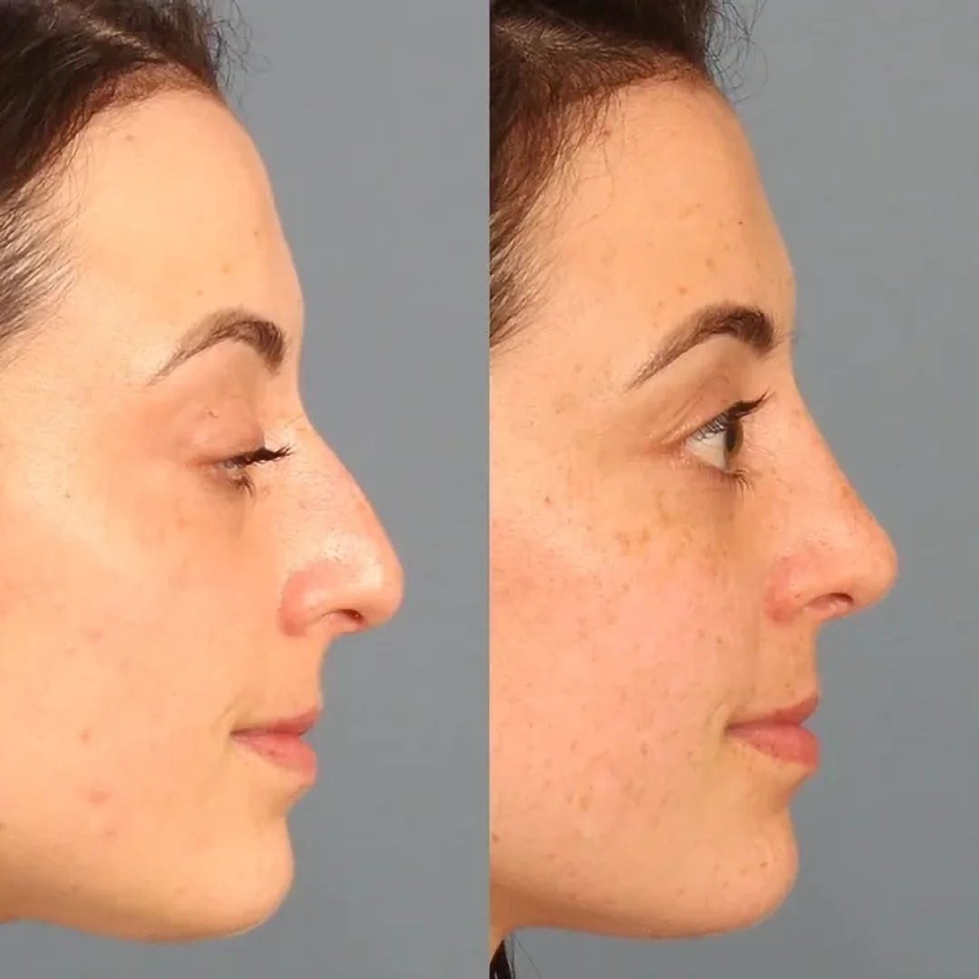 Real patient in Berkeley, CA Performed by Dr David Chou MD