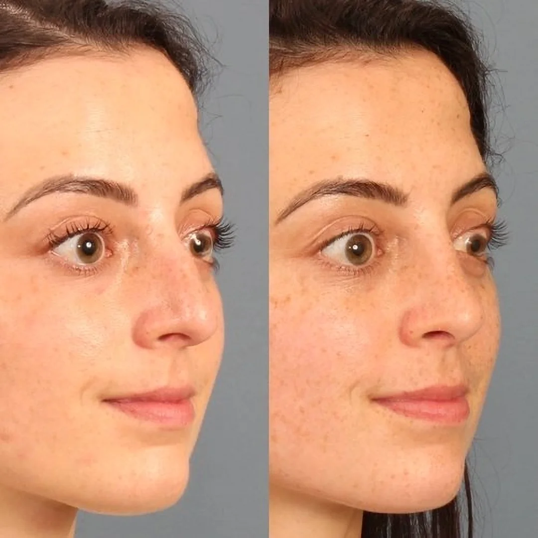 Real patient in Berkeley, CA Performed by Dr David Chou MD