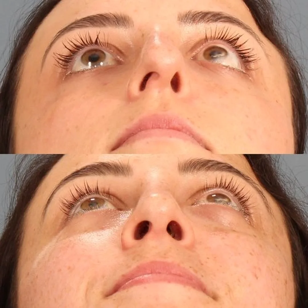 Real patient in Berkeley, CA Performed by Dr David Chou MD