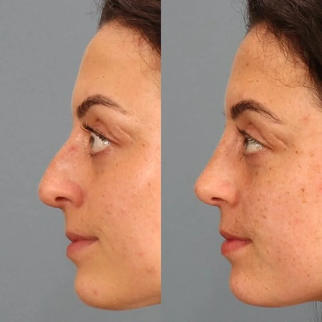 Real patient in Berkeley, CA Performed by Dr David Chou MD