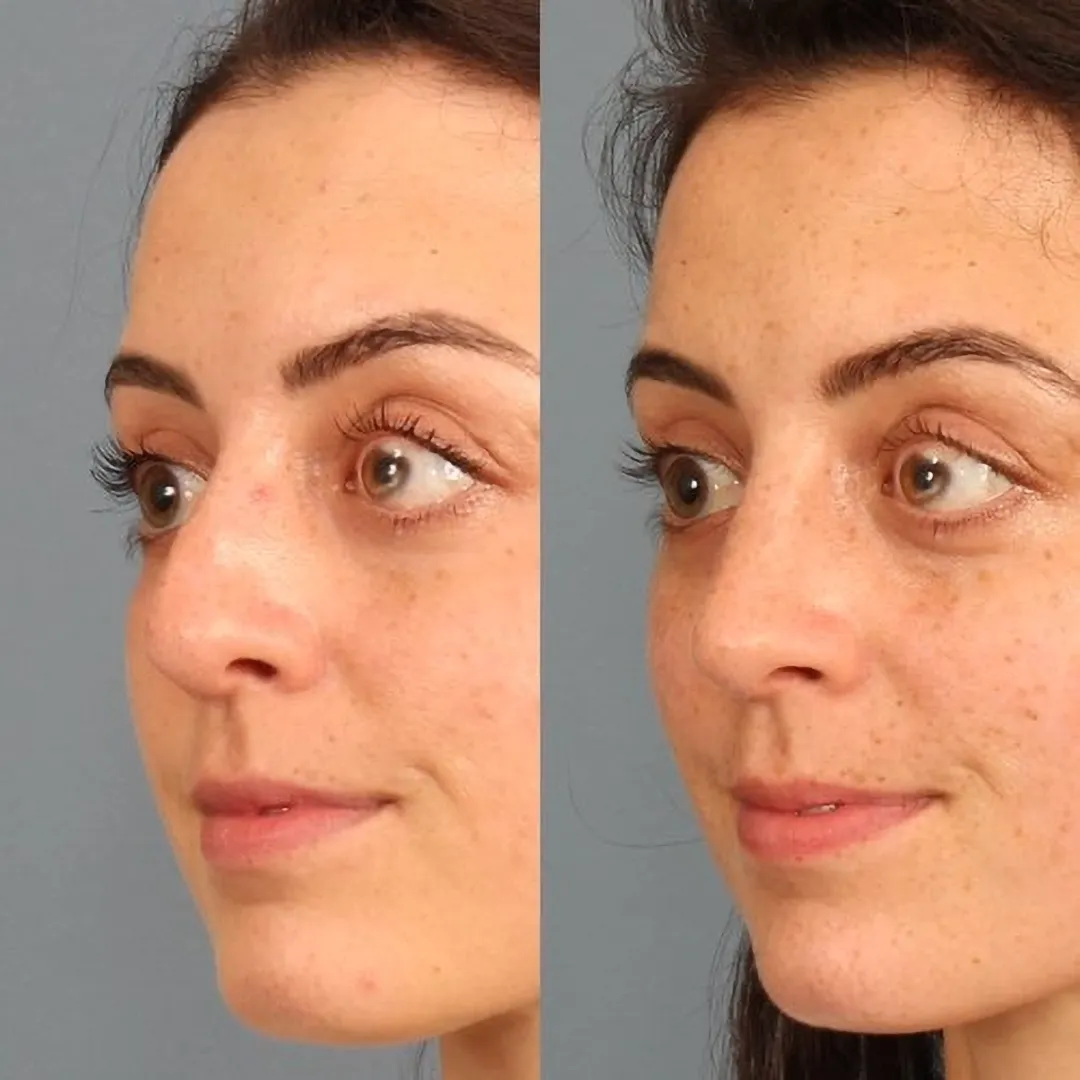Real patient in Berkeley, CA Performed by Dr David Chou MD