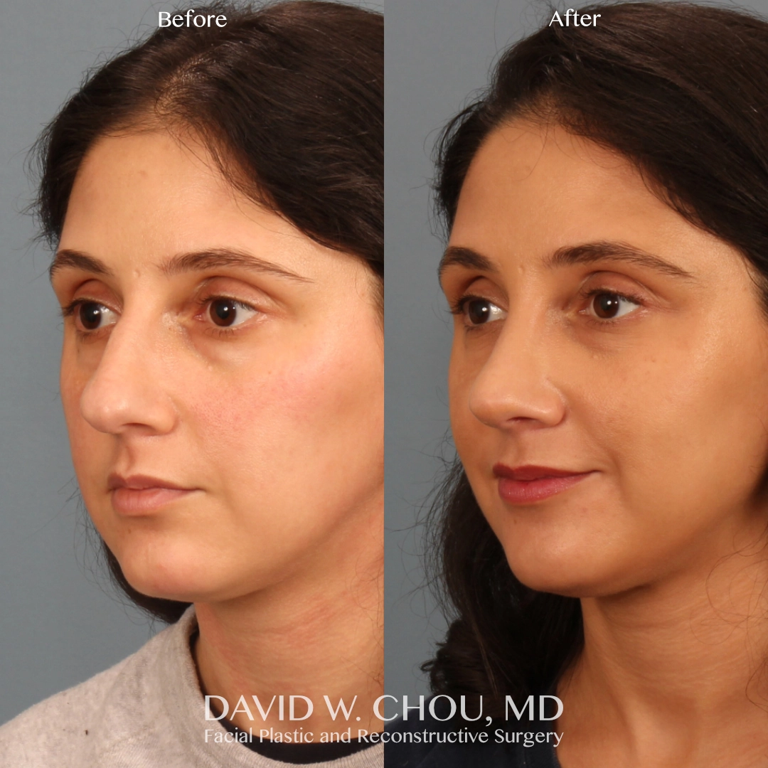 Real patient in Berkeley, CA Performed by Dr David Chou MD