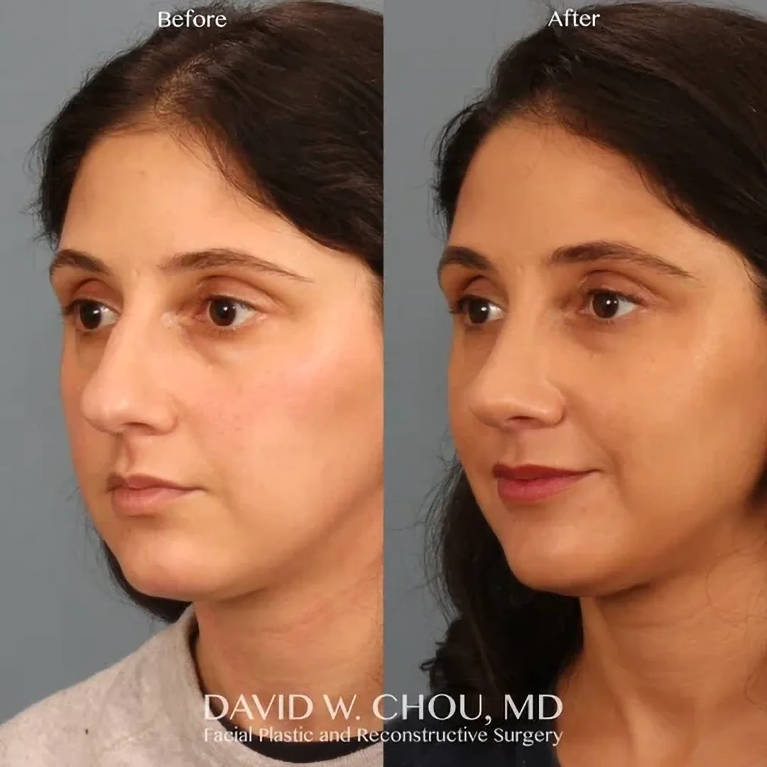 Real patient in Berkeley, CA Performed by Dr David Chou MD