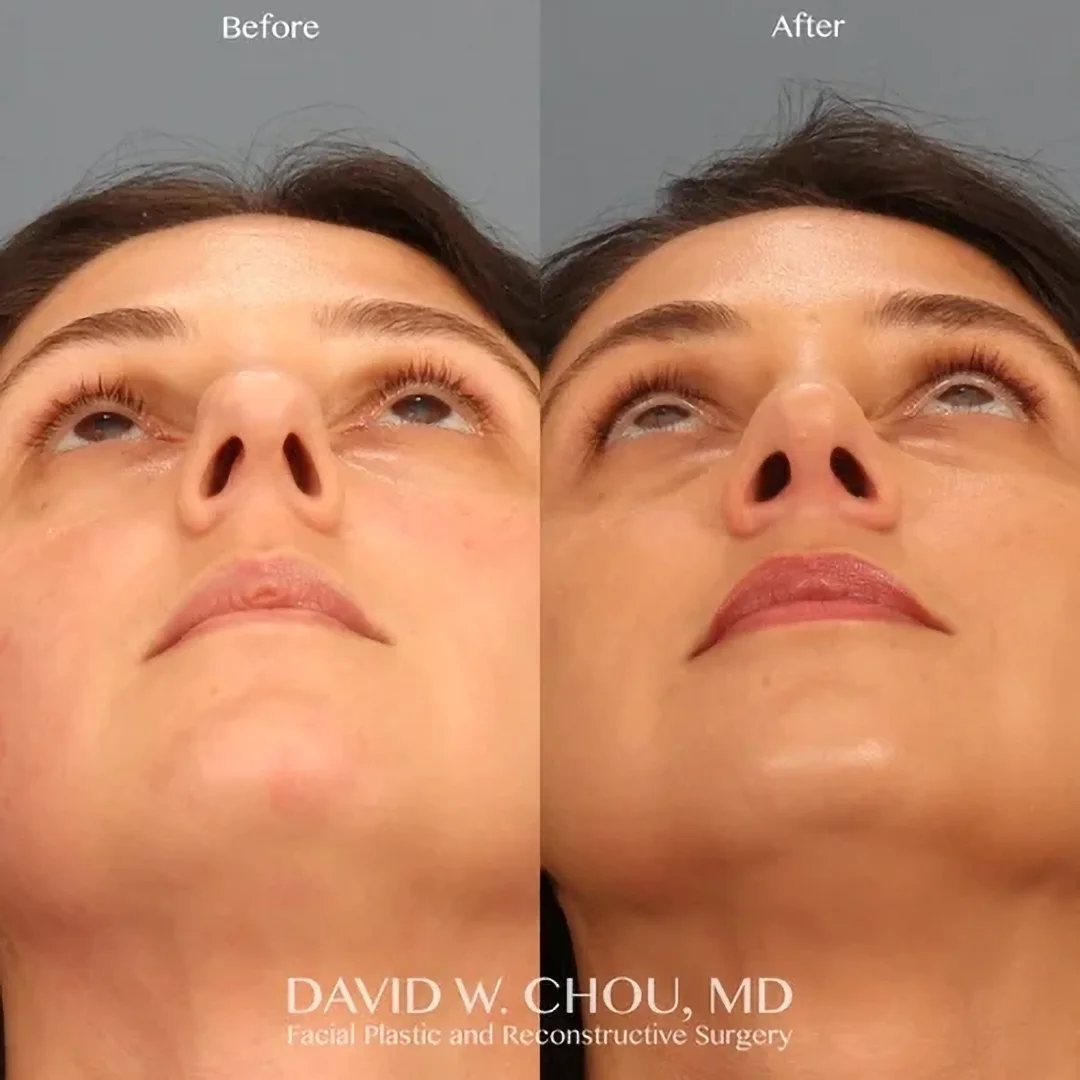 Real patient in Berkeley, CA Performed by Dr David Chou MD