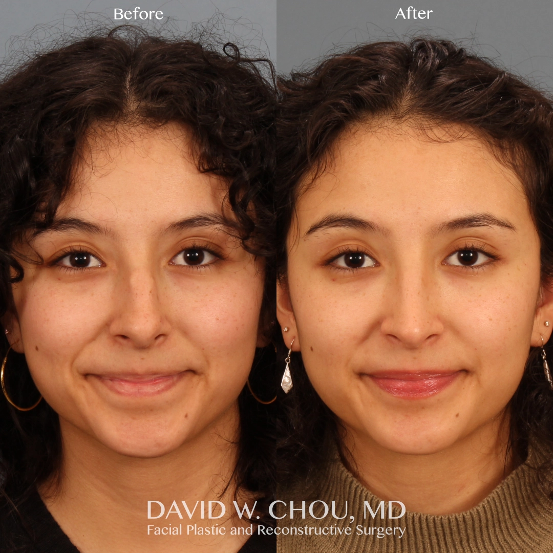 Real patient in Berkeley, CA Performed by Dr David Chou MD