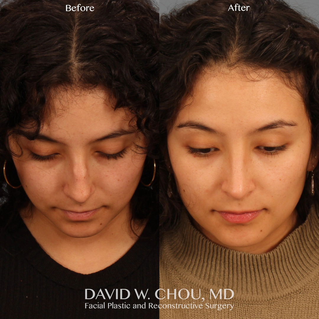 Real patient in Berkeley, CA Performed by Dr David Chou MD