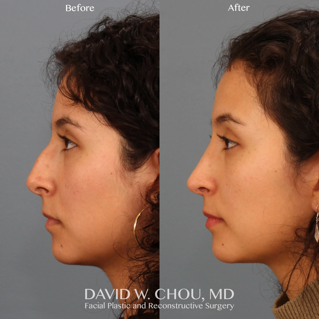 Real patient in Berkeley, CA Performed by Dr David Chou MD