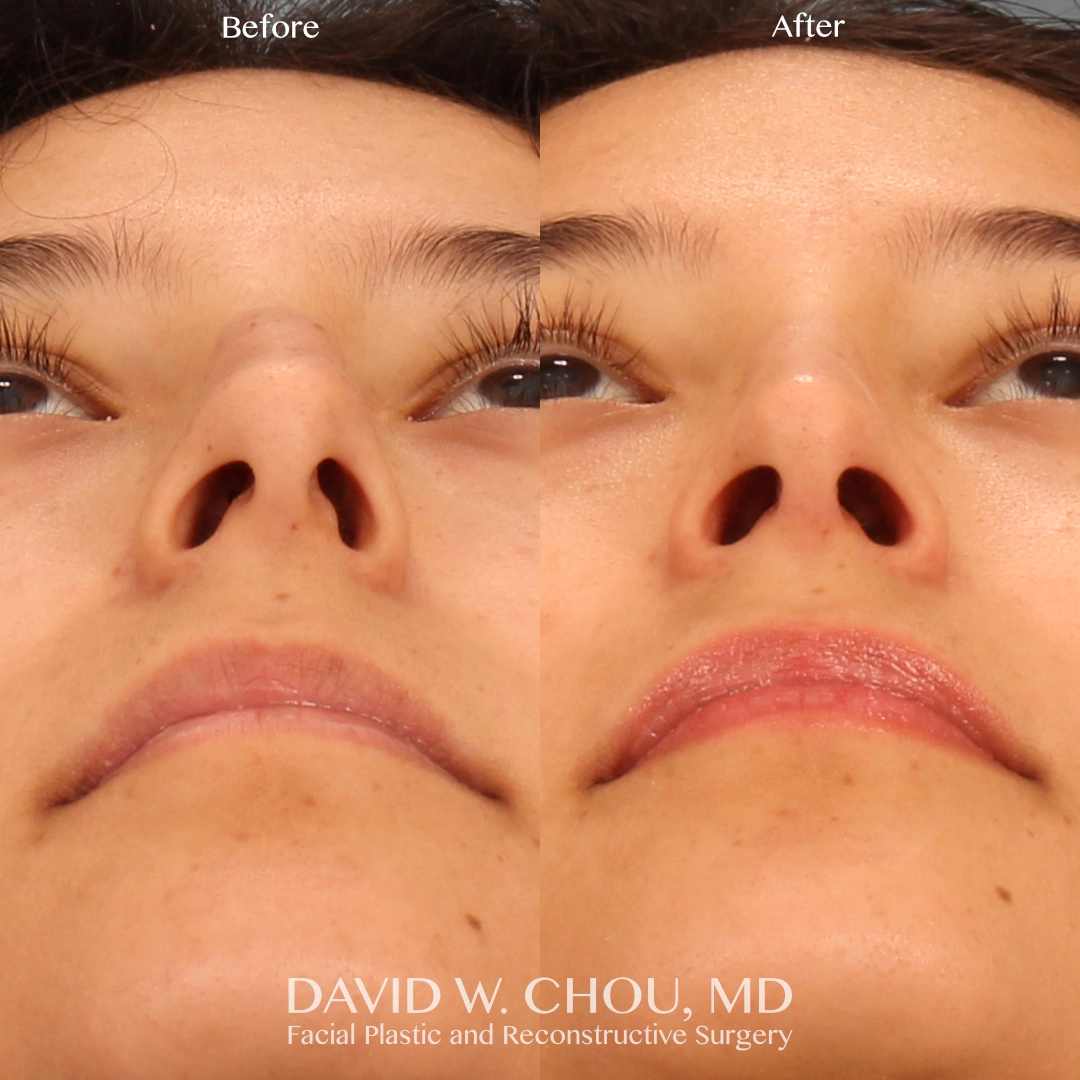 Real patient in Berkeley, CA Performed by Dr David Chou MD