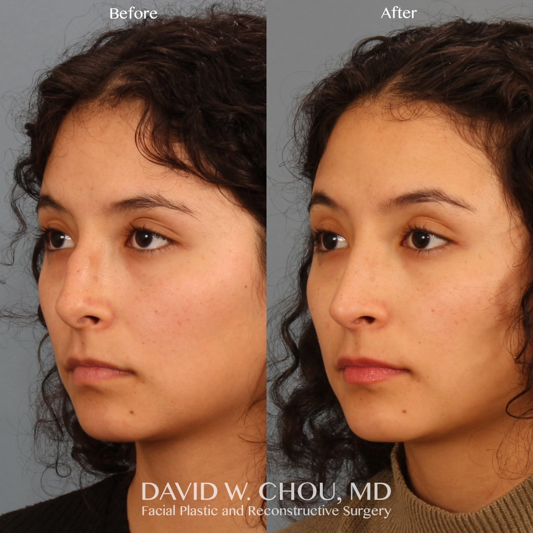 Real patient in Berkeley, CA Performed by Dr David Chou MD