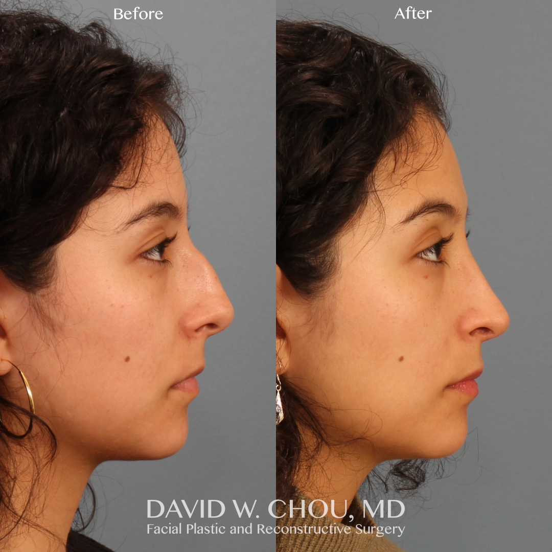 Real patient in Berkeley, CA Performed by Dr David Chou MD
