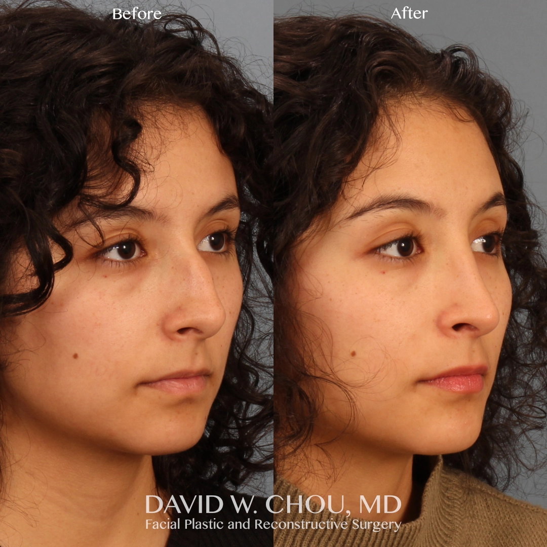 Real patient in Berkeley, CA Performed by Dr David Chou MD