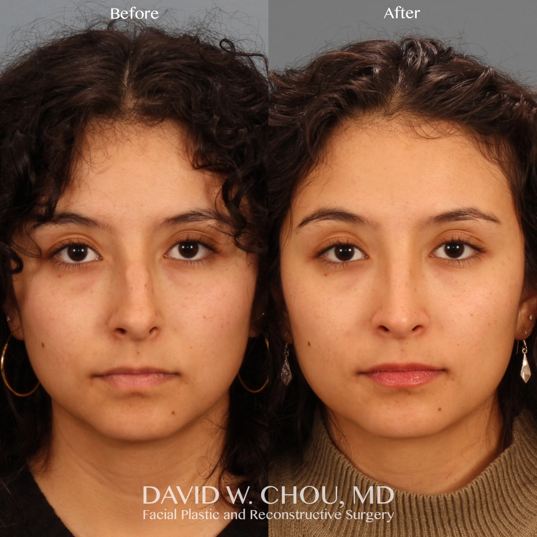 Real patient in Berkeley, CA Performed by Dr David Chou MD