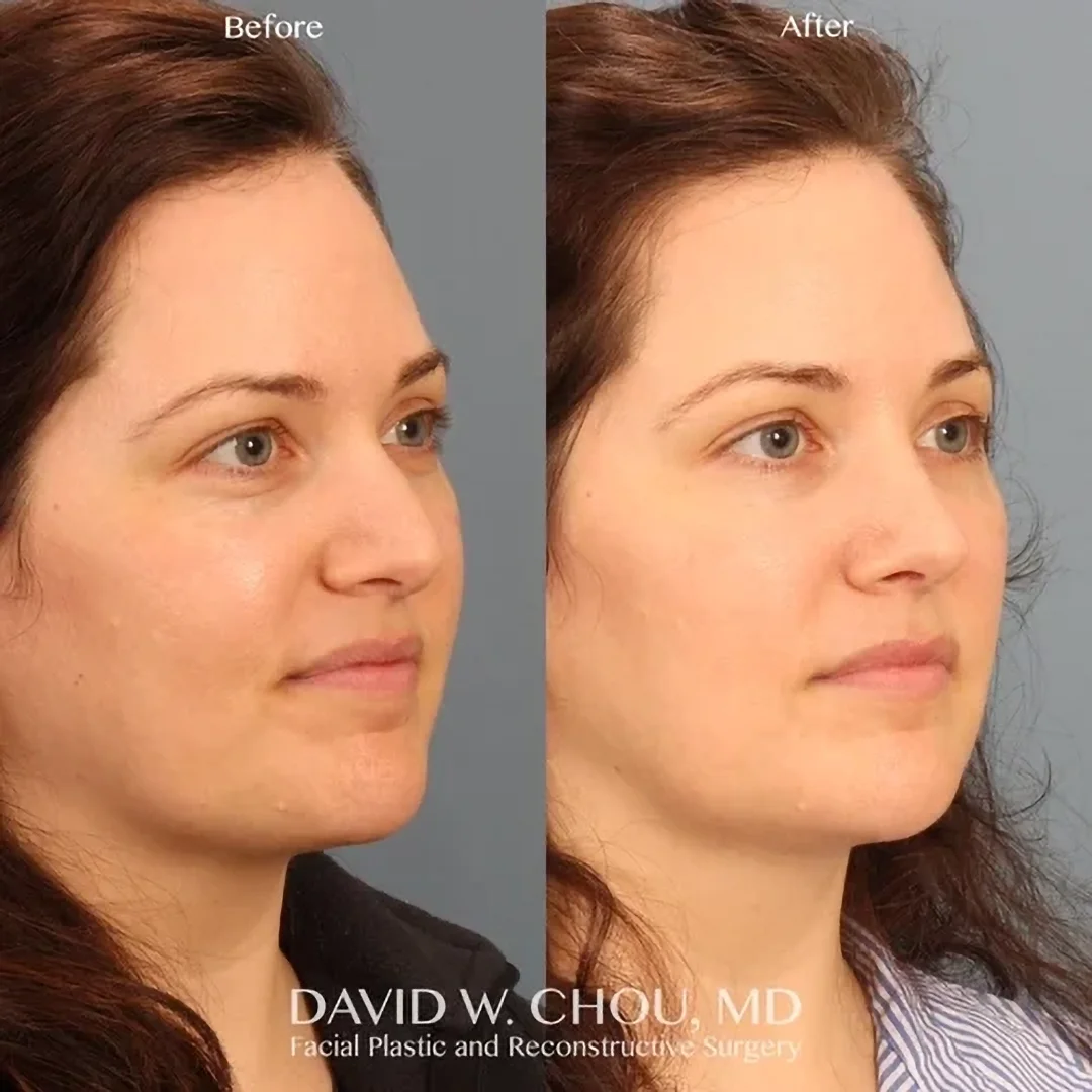 Real patient in Berkeley, CA Performed by Dr David Chou MD