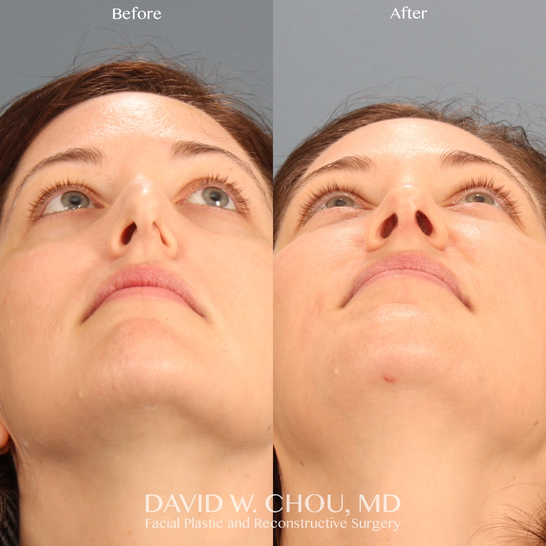 Real patient in Berkeley, CA Performed by Dr David Chou MD