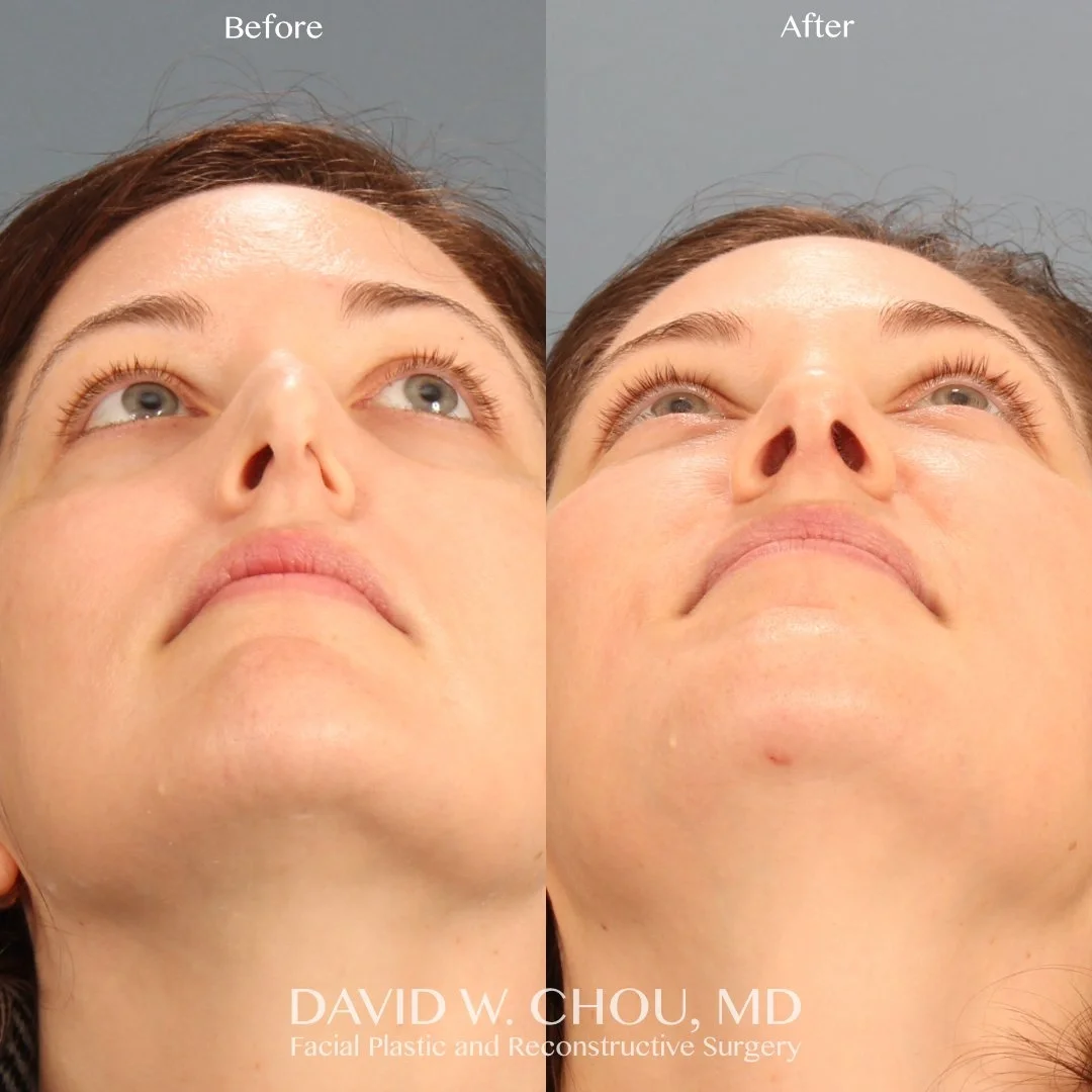 Real patient in Berkeley, CA Performed by Dr David Chou MD