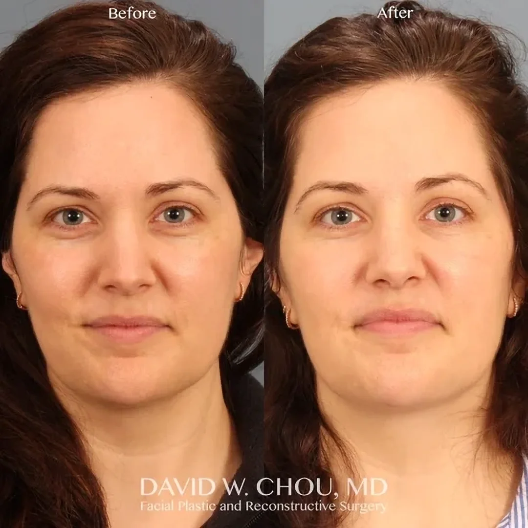 Real patient in Berkeley, CA Performed by Dr David Chou MD
