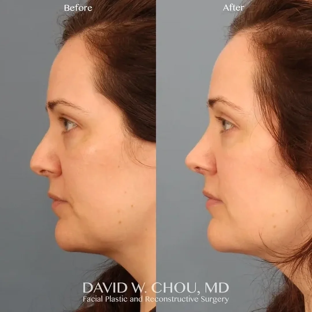 Real patient in Berkeley, CA Performed by Dr David Chou MD