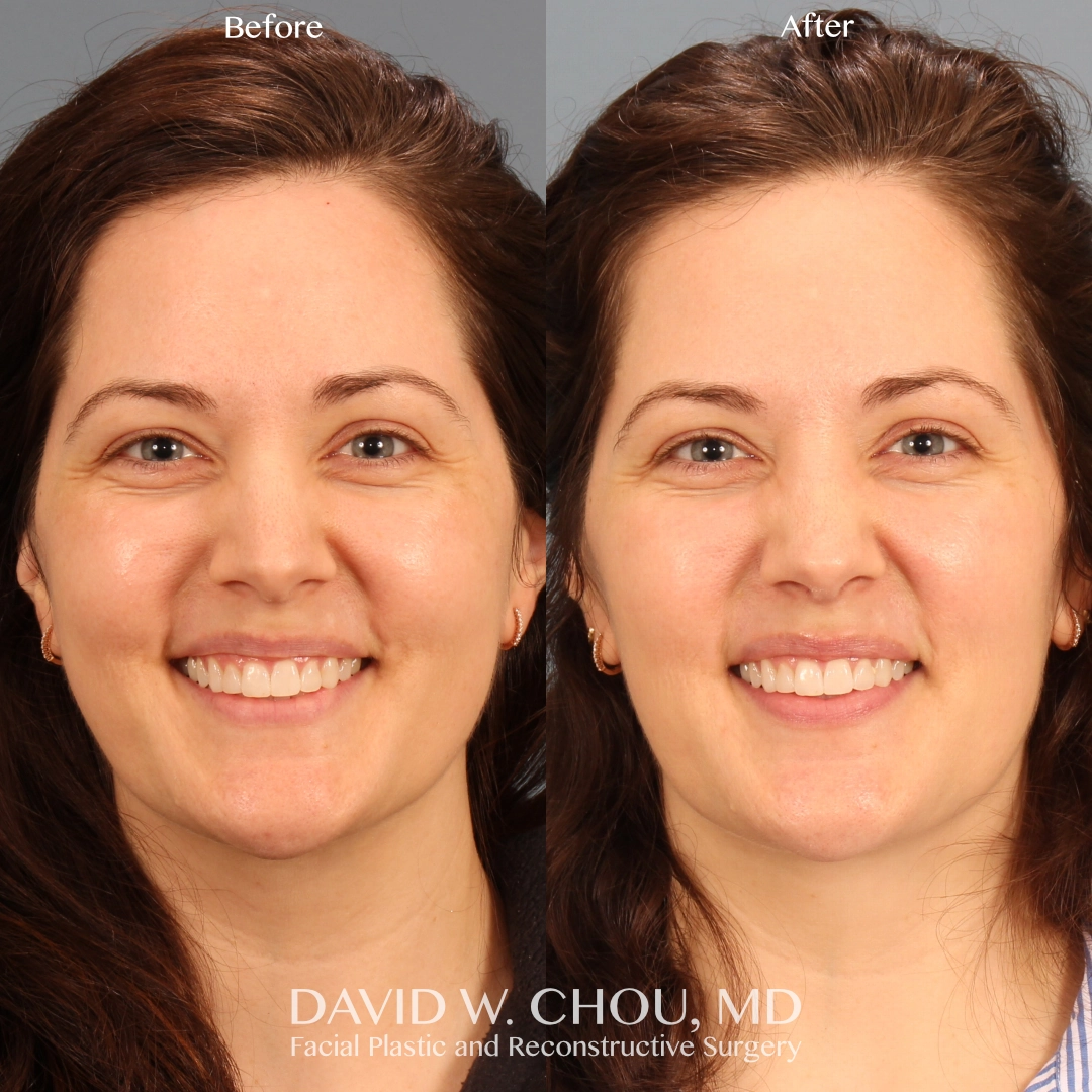 Real patient in Berkeley, CA Performed by Dr David Chou MD