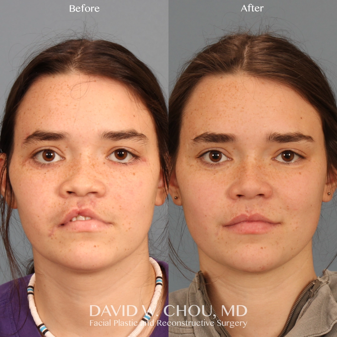 Real patient in Berkeley, CA Performed by Dr David Chou MD