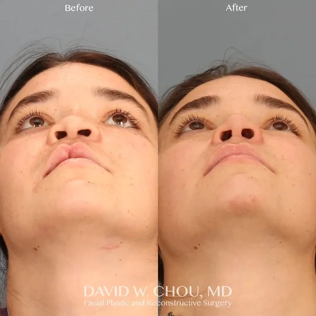 Real patient in Berkeley, CA Performed by Dr David Chou MD