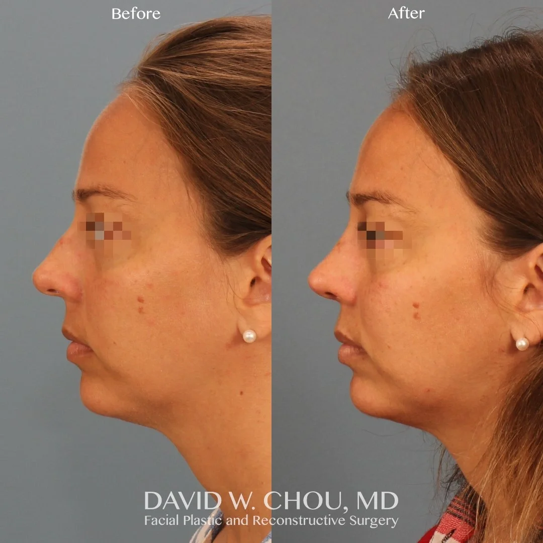 Real patient in Berkeley, CA Performed by Dr David Chou MD