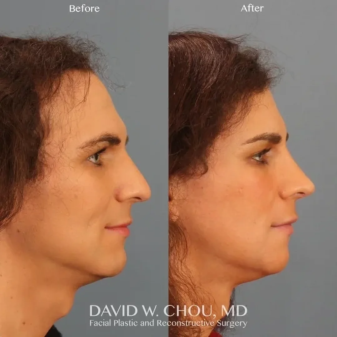 Real patient in Berkeley, CA Performed by Dr David Chou MD