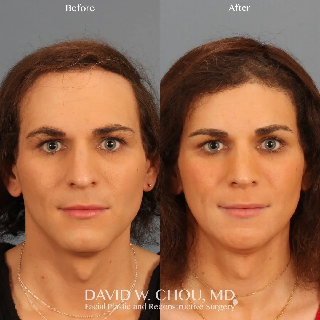 Real patient in Berkeley, CA Performed by Dr David Chou MD