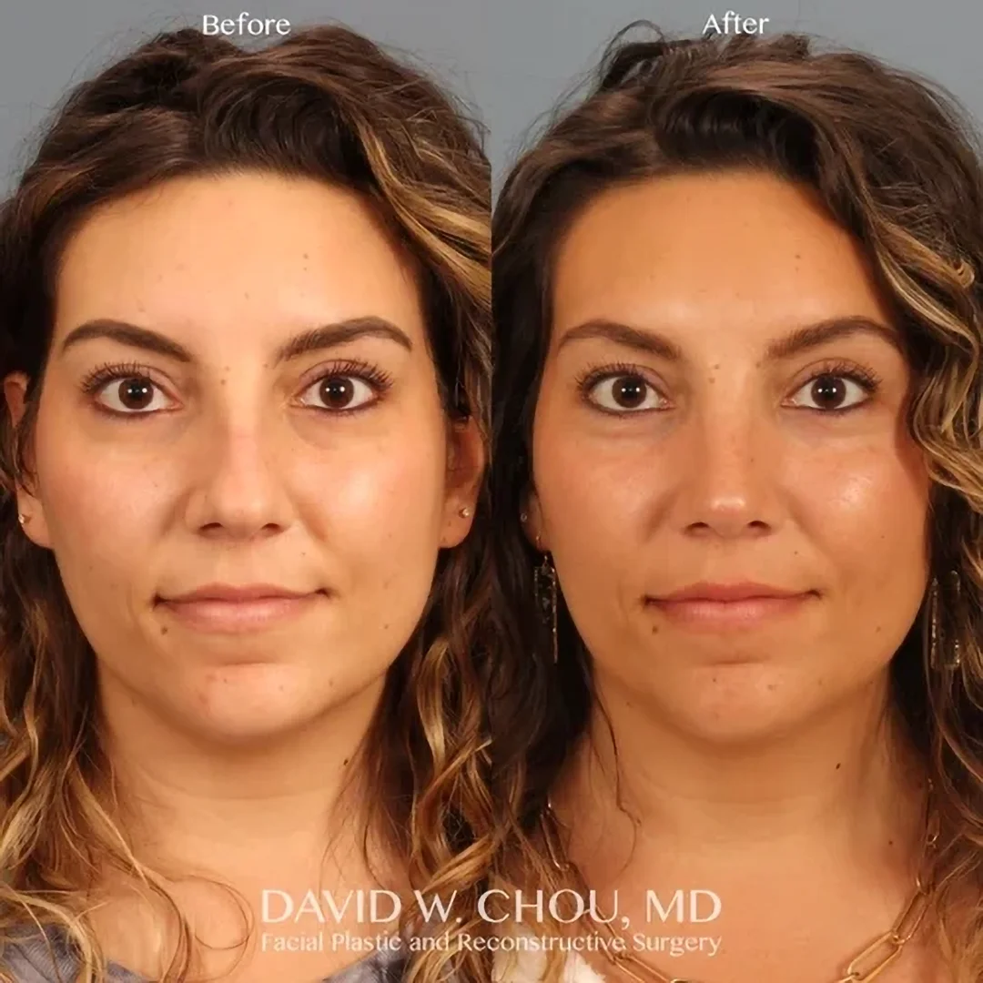 Real patient in Berkeley, CA Performed by Dr David Chou MD