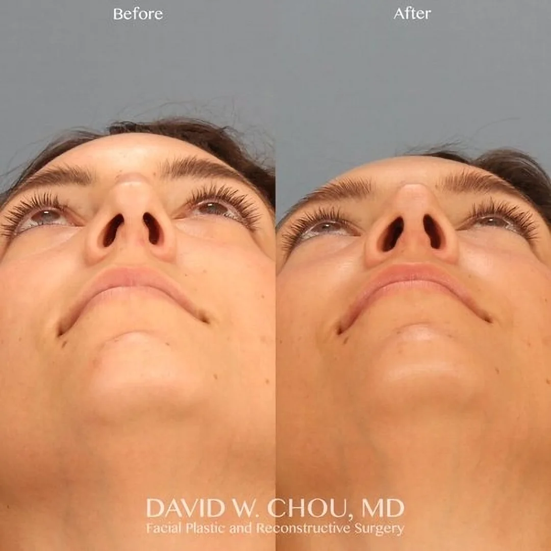 Real patient in Berkeley, CA Performed by Dr David Chou MD
