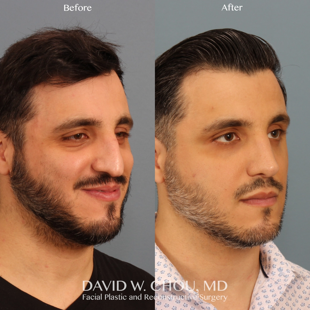 Real patient in Berkeley, CA Performed by Dr David Chou MD