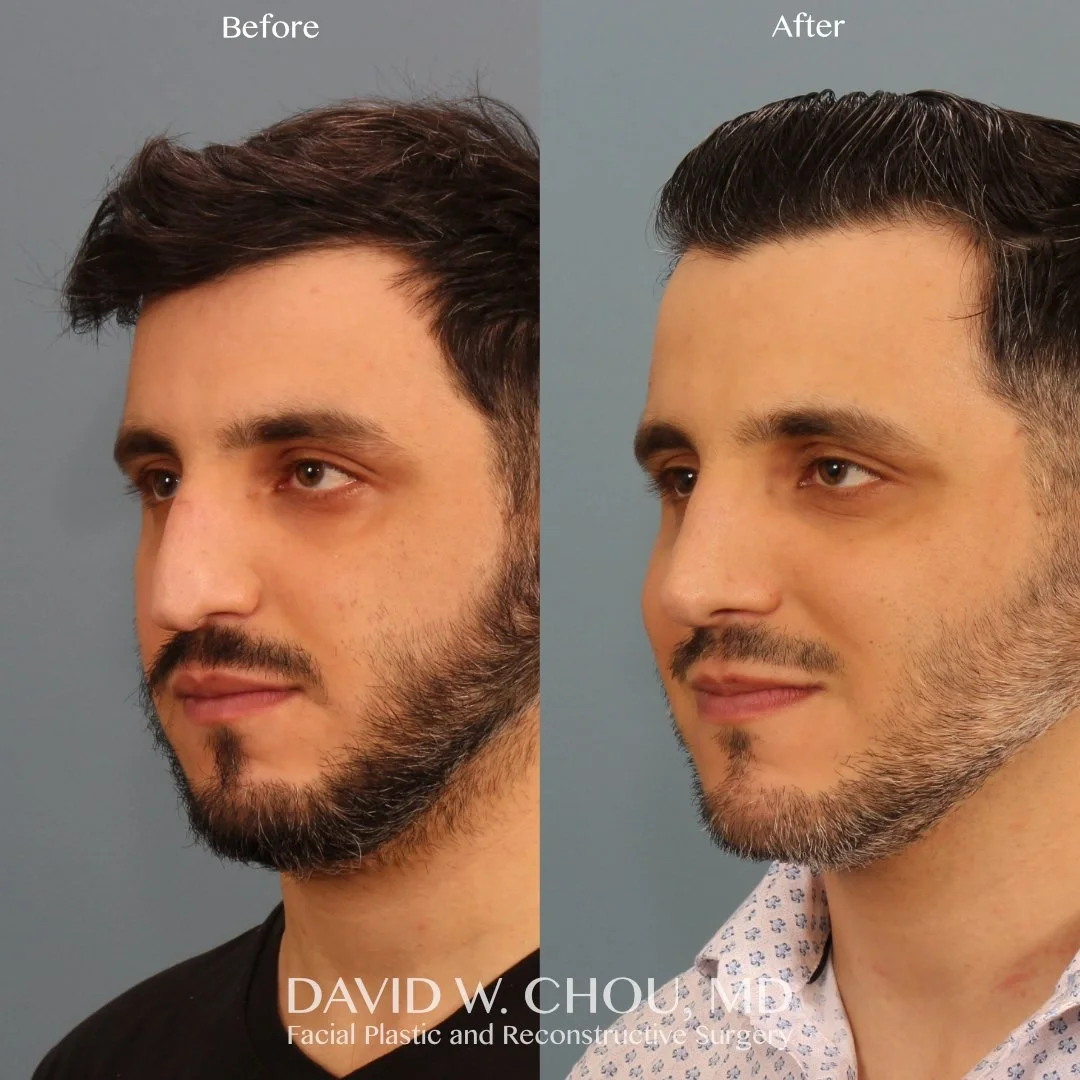 Real patient in Berkeley, CA Performed by Dr David Chou MD