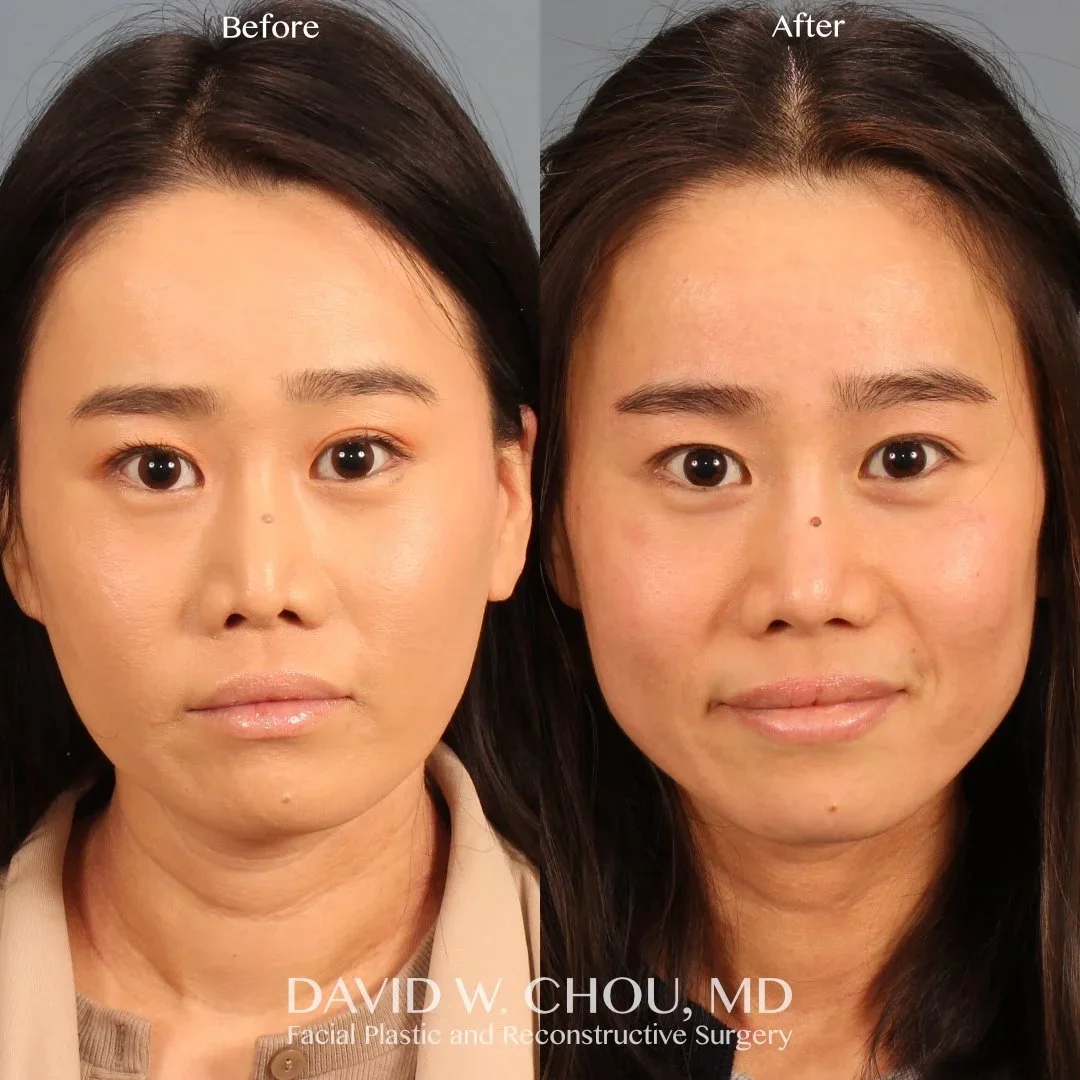 Real patient in Berkeley, CA Performed by Dr David Chou MD