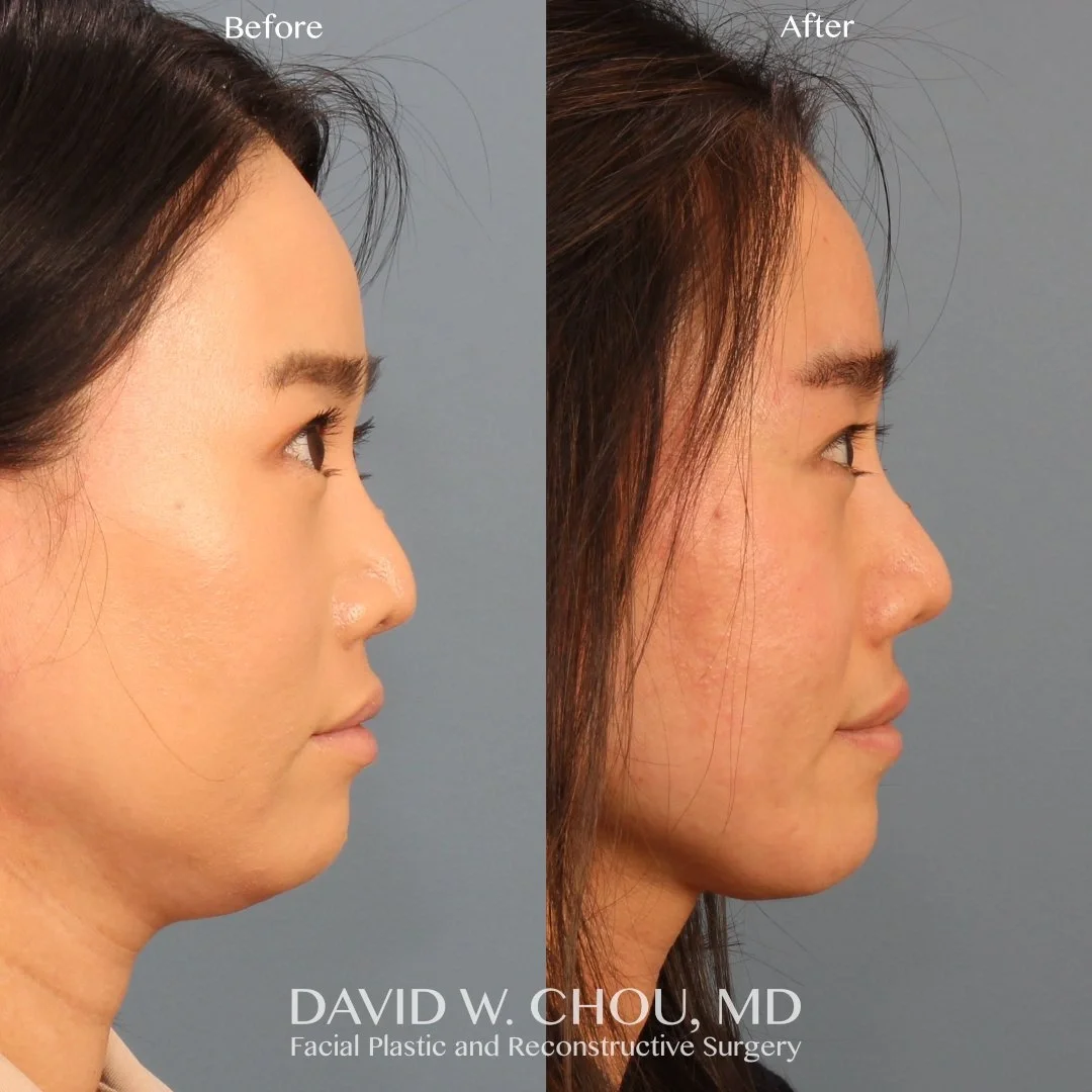 Real patient in Berkeley, CA Performed by Dr David Chou MD