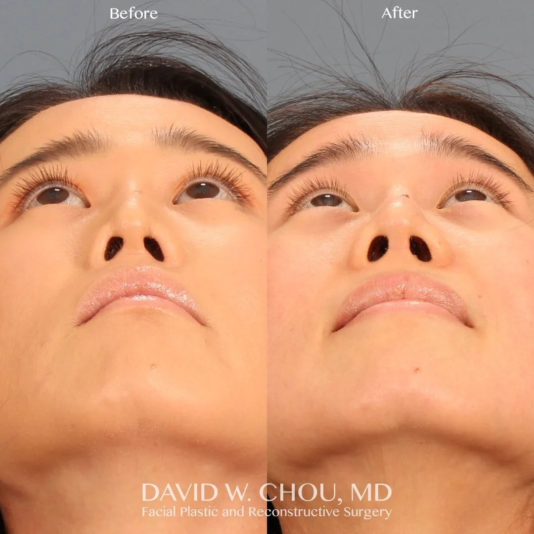 Real patient in Berkeley, CA Performed by Dr David Chou MD