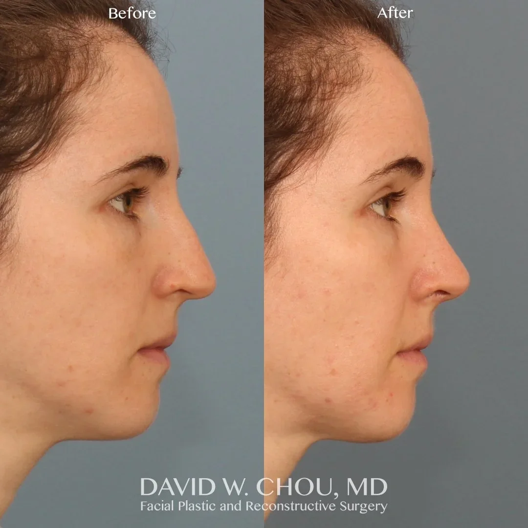 Real patient in Berkeley, CA Performed by Dr David Chou MD