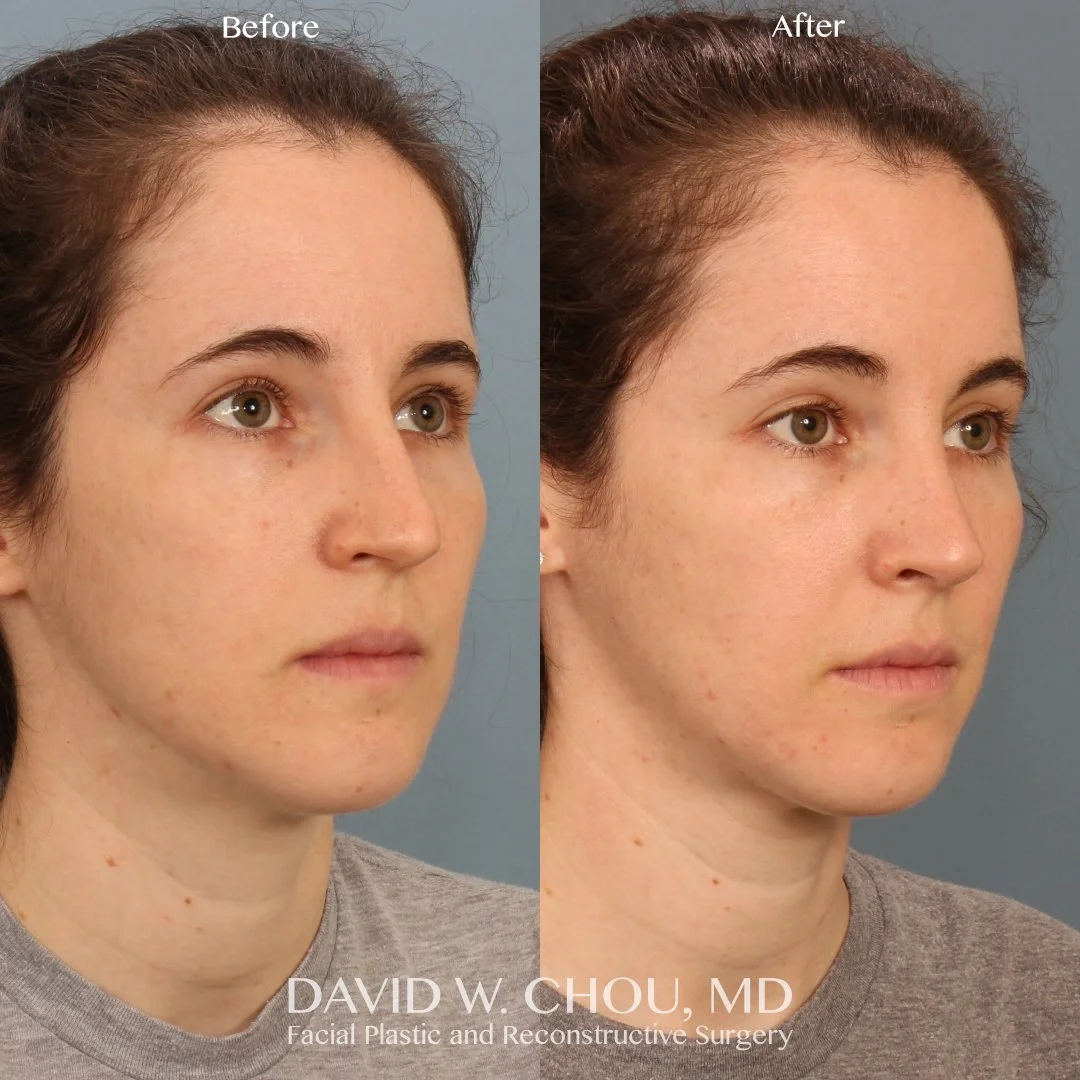 Real patient in Berkeley, CA Performed by Dr David Chou MD