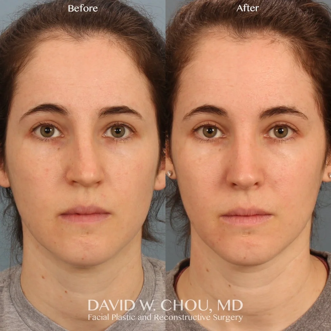Real patient in Berkeley, CA Performed by Dr David Chou MD