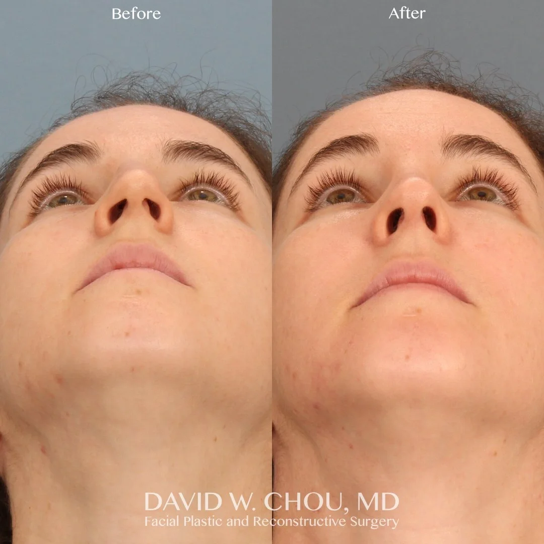 Real patient in Berkeley, CA Performed by Dr David Chou MD
