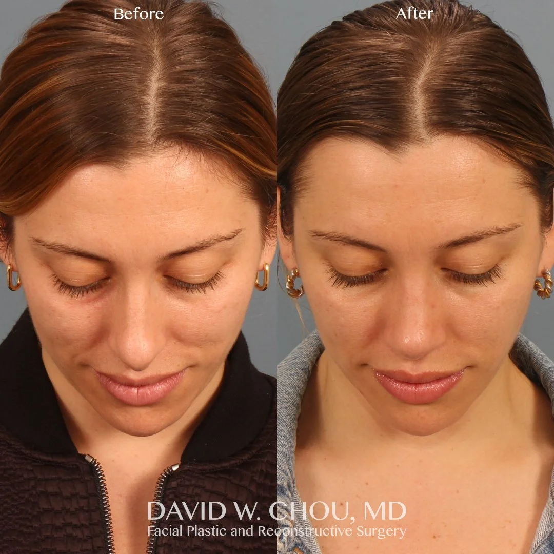 Real patient in Berkeley, CA Performed by Dr David Chou MD