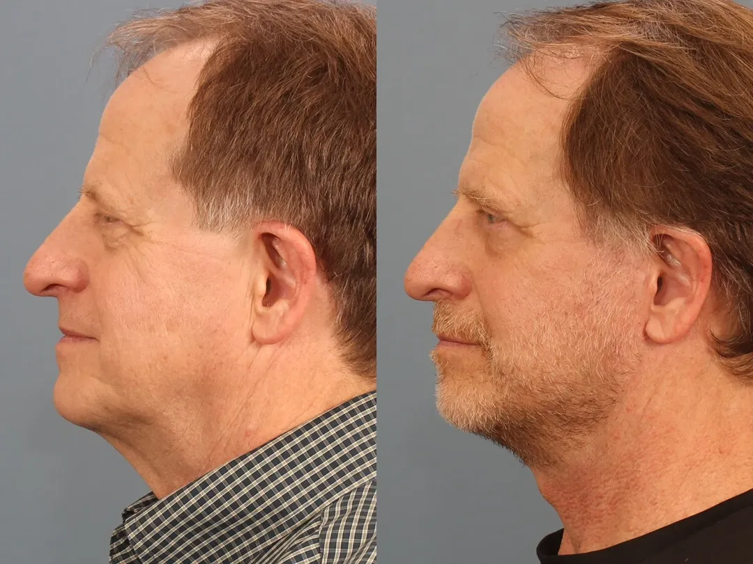 Real patient in Berkeley, CA Performed by Dr David Chou MD