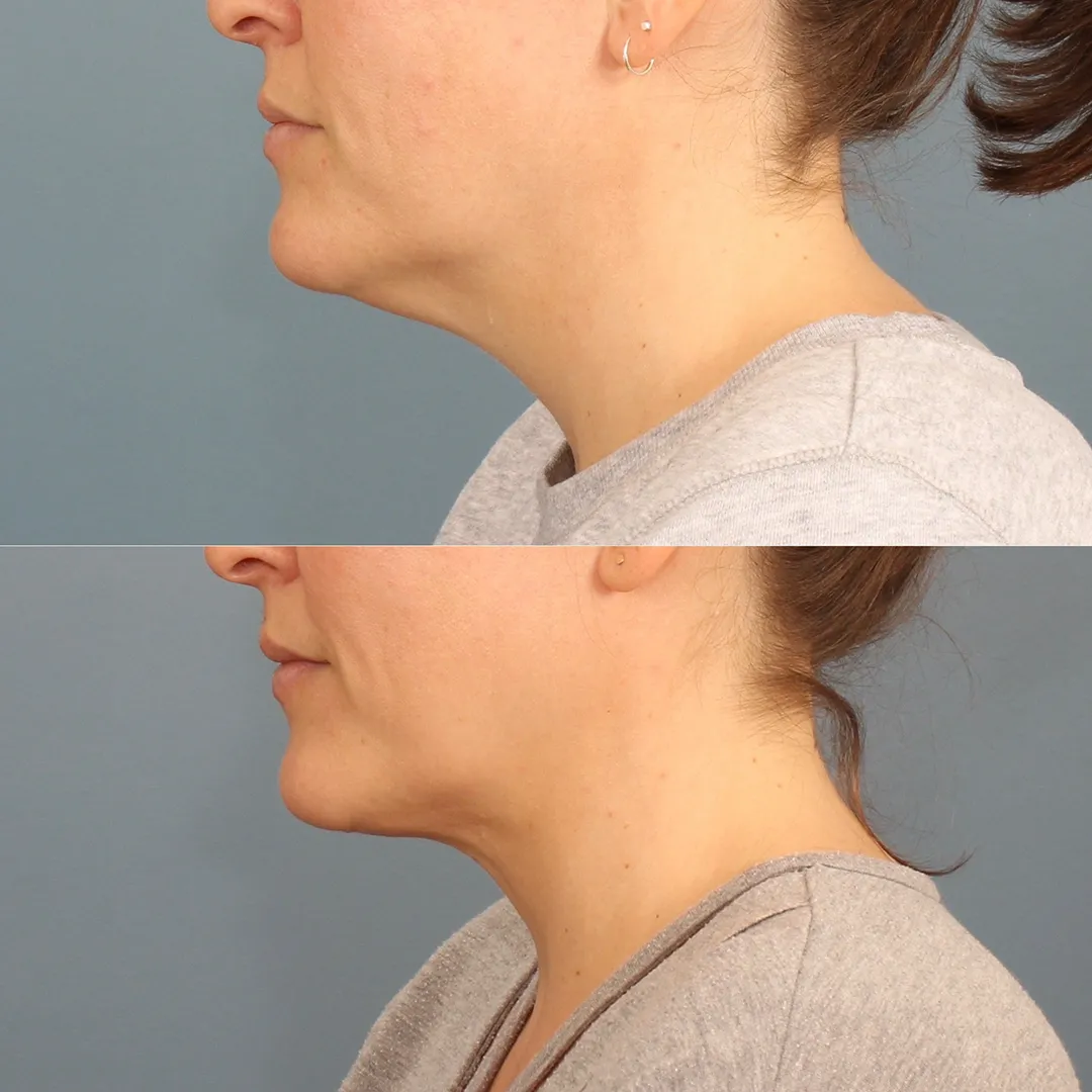 Real patient in Berkeley, CA Performed by Dr David Chou MD