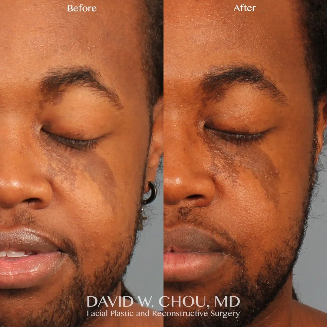 Real patient in Berkeley, CA Performed by Dr David Chou MD
