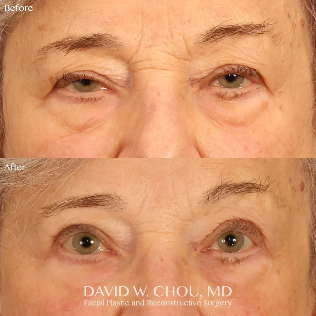 Real patient in Berkeley, CA Performed by Dr David Chou MD