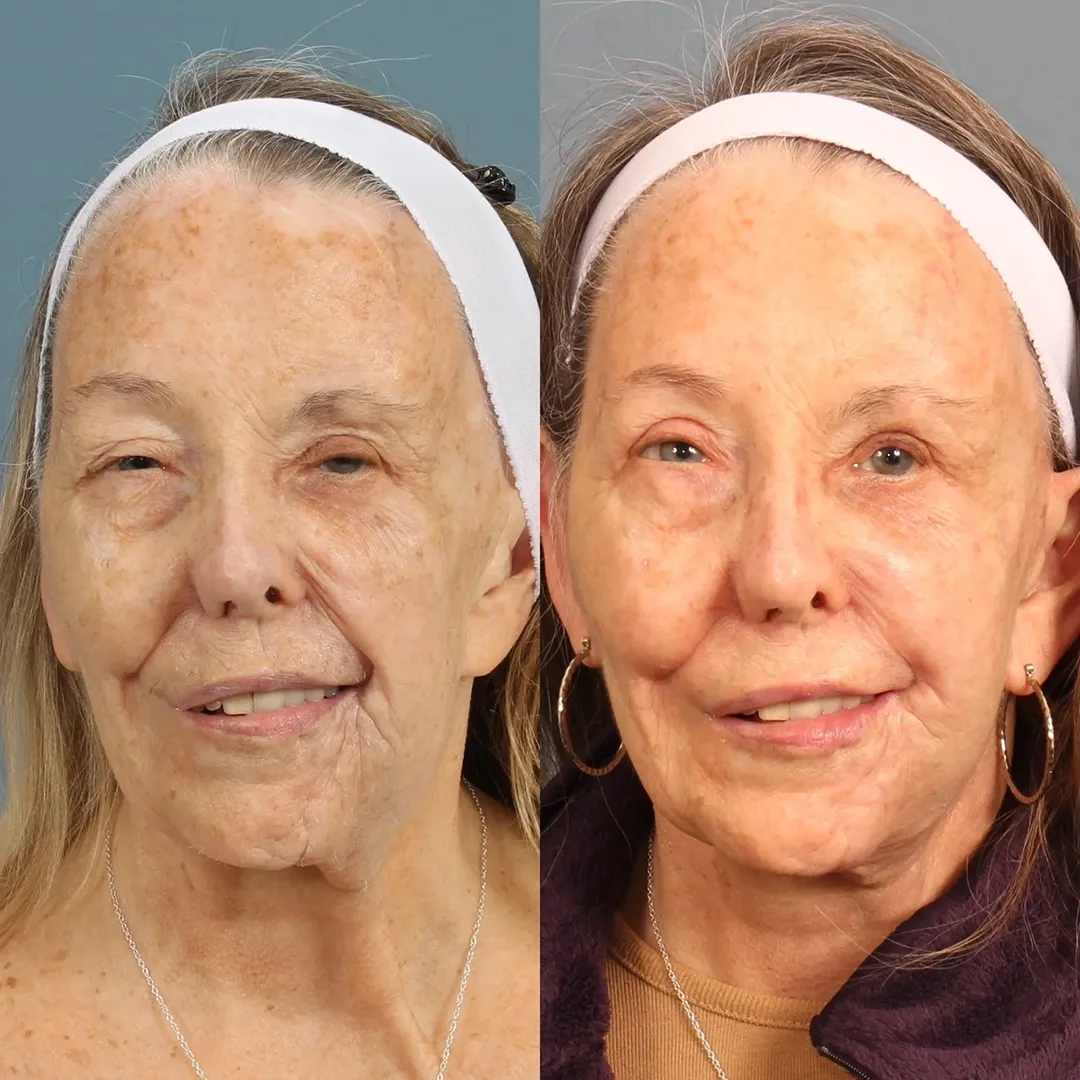 Real patient in Berkeley, CA Performed by Dr David Chou MD