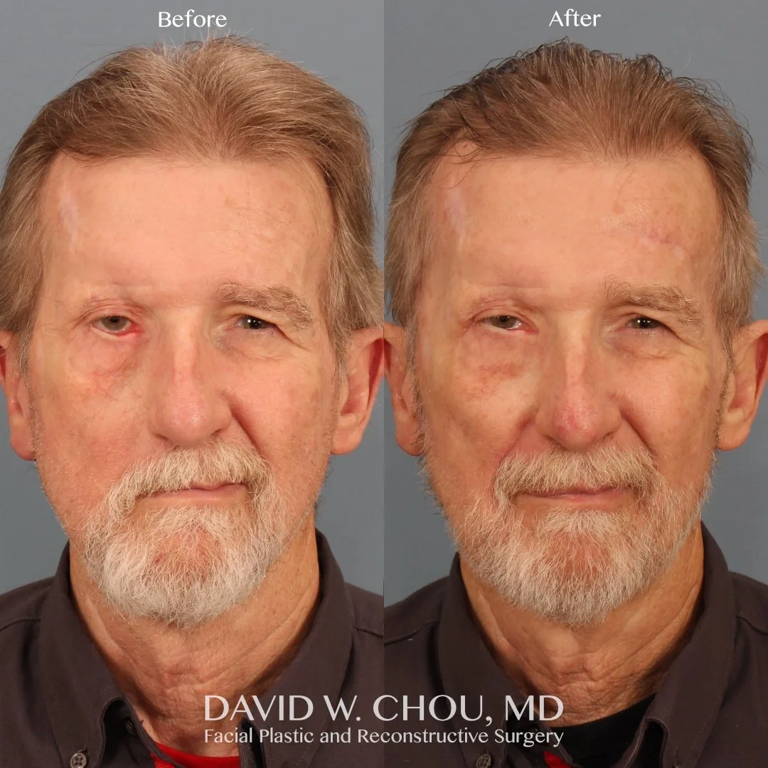 Real patient in Berkeley, CA Performed by Dr David Chou MD