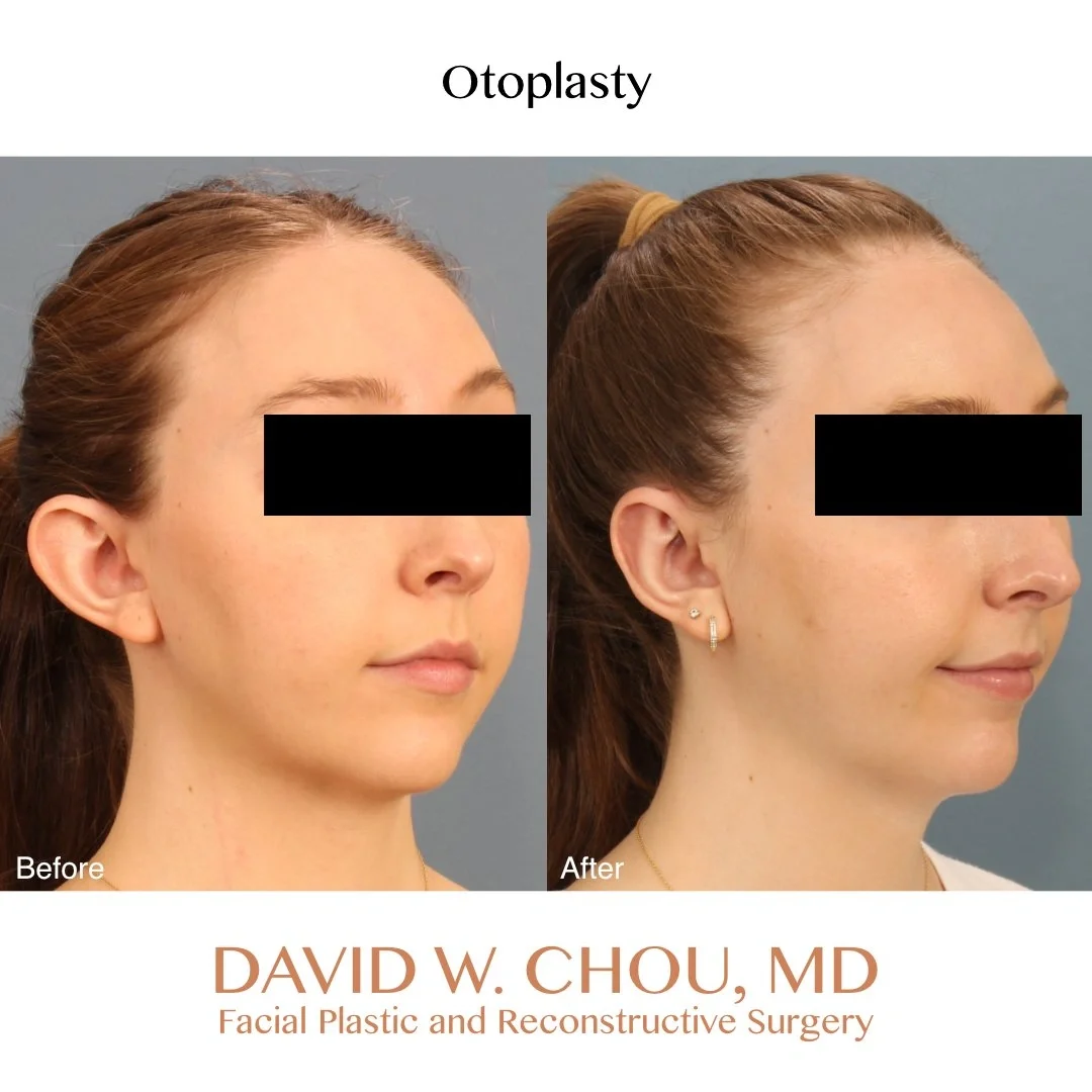 Real patient in Berkeley, CA Performed by Dr David Chou MD