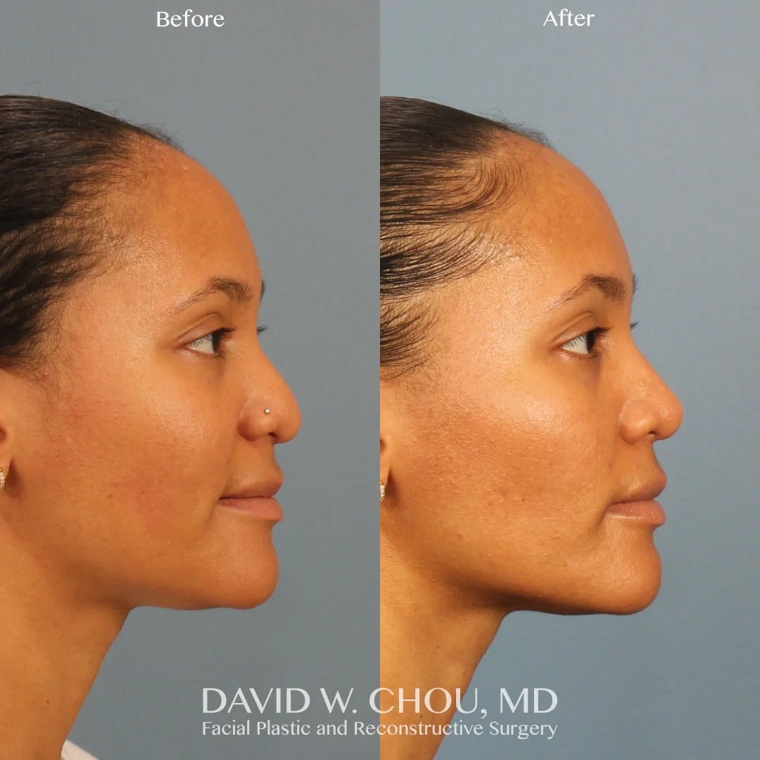 Real patient in Berkeley, CA Performed by Dr David Chou MD